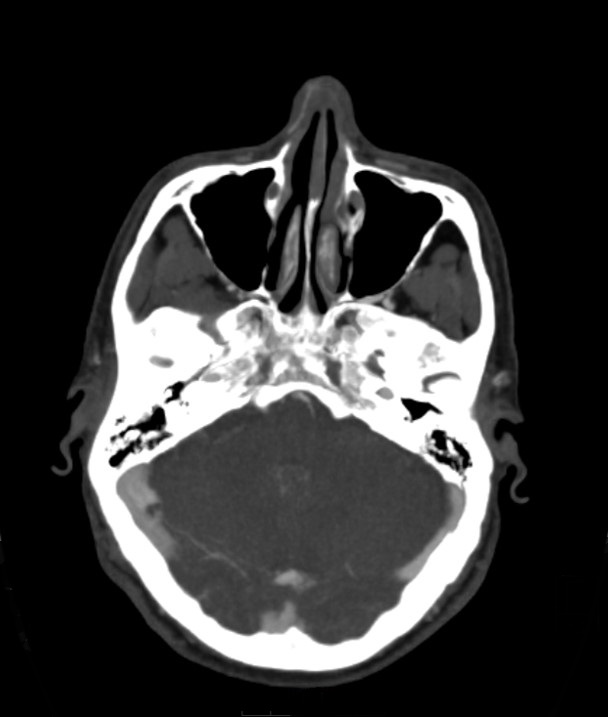 Basilar artery thrombosis and ascending transtentorial herniation (Radiopaedia 84759-100360 B 46).jpg