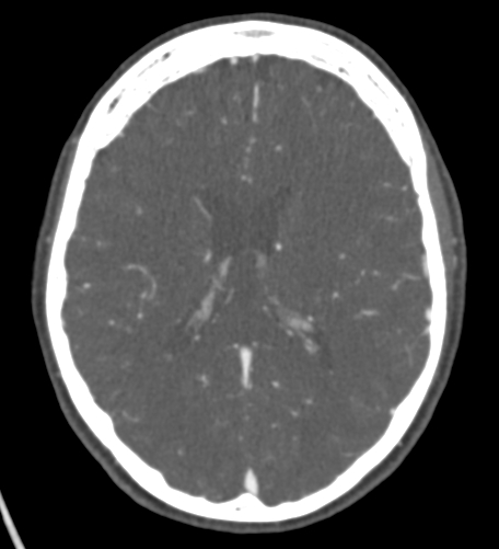 Basilar tip aneurysm with coiling (Radiopaedia 53912-60086 A 89).jpg
