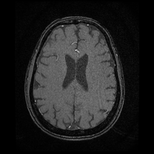 Basilar top and left middle cerebral artery aneurysm (Radiopaedia 61965-70031 Axial MRA 113).jpg