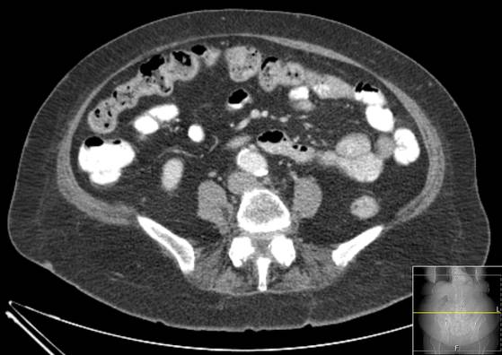 Bicameral celiacomesenteric aneurysm (Radiopaedia 55766-62327 A 39).jpg