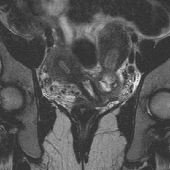 File:Bicornuate uterus (Radiopaedia 24677-24949 Coronal T2 7).jpg