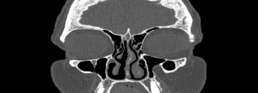 Bilateral Ectopic Infraorbital Nerves (Radiopaedia 49006-54084 Coronal bone window 15).jpg
