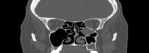 File:Bilateral Ectopic Infraorbital Nerves (Radiopaedia 49006-54084 Coronal bone window 45).jpg