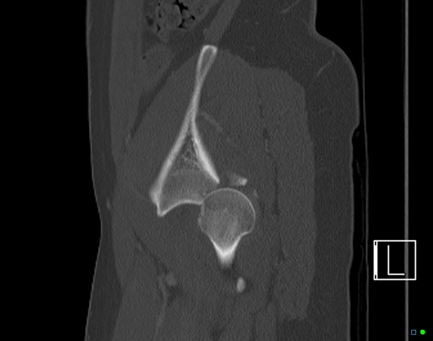 Bilateral acetabular fractures (Radiopaedia 79272-92308 Sagittal bone window 72).jpg