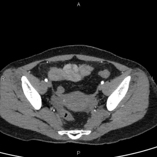 Bilateral adrenal gland hyperenhancement in pancreatitis (Radiopaedia 86642-102753 B 109).jpg