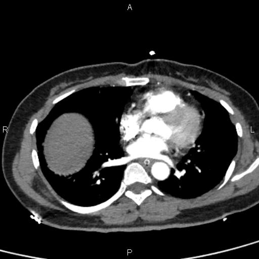 File:Bilateral adrenal gland hyperenhancement in pancreatitis (Radiopaedia 86642-102753 B 2).jpg