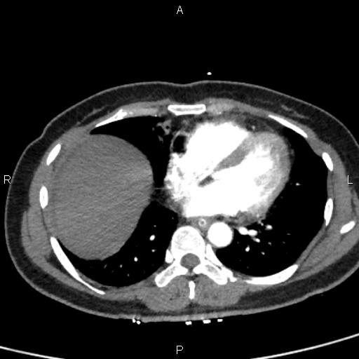 Bilateral adrenal gland hyperenhancement in pancreatitis (Radiopaedia 86642-102753 B 5).jpg