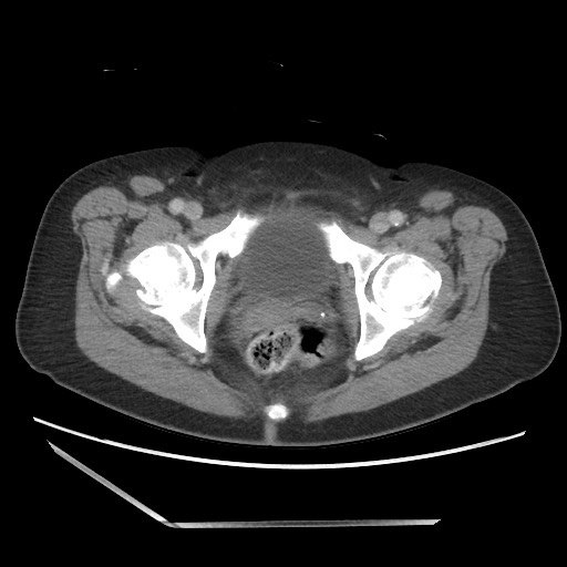 Bilateral adrenal granulocytic sarcomas (chloromas) (Radiopaedia 78375-91007 A 115).jpg