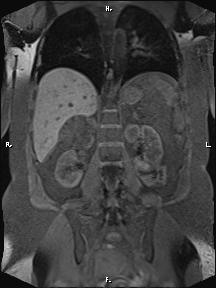 Bilateral adrenal myelolipoma (Radiopaedia 63058-71537 Coronal T1 fat sat 40).jpg