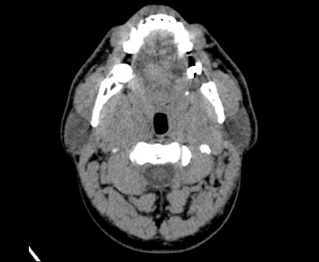 Bilateral carotid body tumors (Radiopaedia 61841-69870 Axial non-contrast 28).jpg