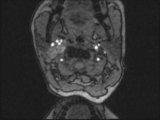 Bilateral carotid body tumors and right glomus jugulare tumor (Radiopaedia 20024-20060 Axial MRA 279).jpg