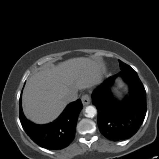 File:Bilateral delayed nephrogram from renal artery stenosis (Radiopaedia 47681-52362 A 7).png