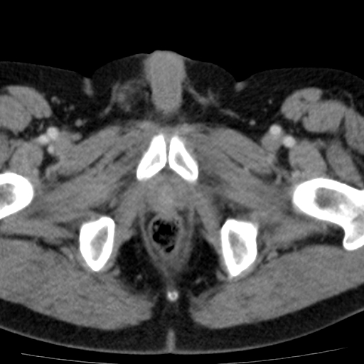 File:Bilateral direct inguinal herniae (Radiopaedia 17016-16719 B 26).jpg