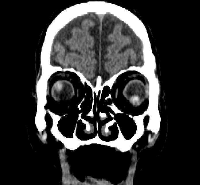 Bilateral ectopia lentis (Radiopaedia 89889-107013 Coronal non-contrast 47).jpg