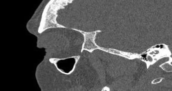 File:Bilateral ectopic infraorbital nerves (Radiopaedia 49006-54084 Sagittal 39).png