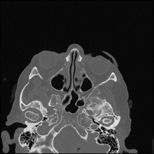 Bilateral frontal mucoceles (Radiopaedia 82352-96454 Axial bone window 164).jpg
