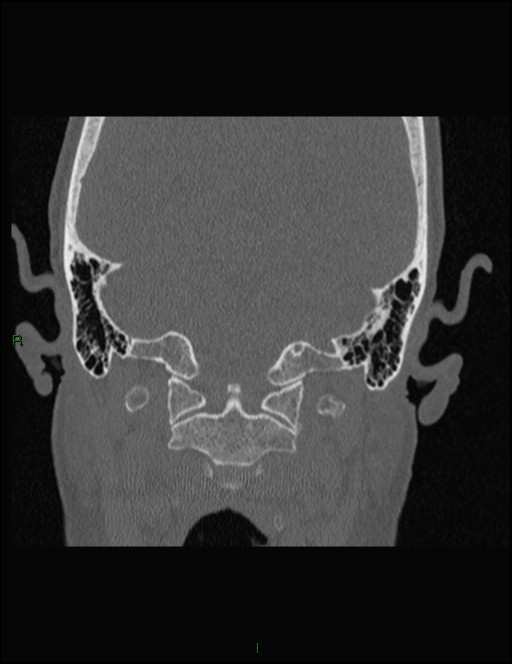Bilateral frontal mucoceles (Radiopaedia 82352-96454 Coronal 351).jpg
