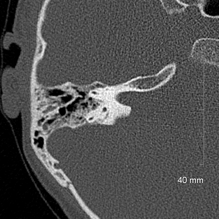 Bilateral grommets (Radiopaedia 47710-52404 Axial bone window 49).jpg