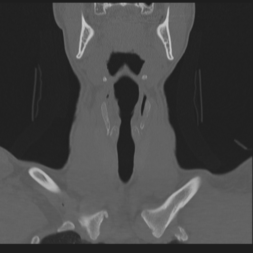 File:Bilateral locked facets (Radiopaedia 33850-35016 Coronal bone window 22).png