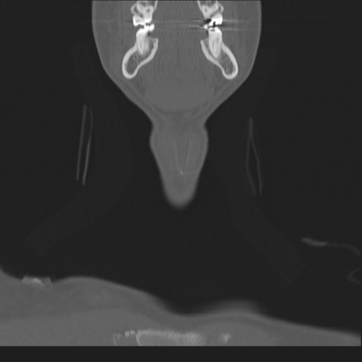 Bilateral locked facets (Radiopaedia 33850-35016 Coronal bone window 6).png