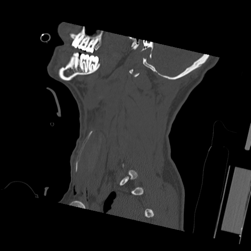 File:Bilateral locked facets (Radiopaedia 33850-35023 Sagittal bone window 52).png