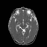 File:Bilateral mesial temporal polymicrogyria (Radiopaedia 76456-88181 Axial ADC 11).jpg