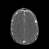 File:Bilateral mesial temporal polymicrogyria (Radiopaedia 76456-88181 Axial ADC 18).jpg