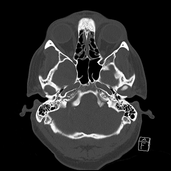 Bilateral occipital condyle fracture (type 2) (Radiopaedia 87675-104089 Axial bone window 24).jpg