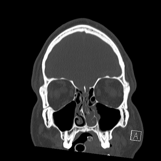 Bilateral occipital condyle fracture (type 2) (Radiopaedia 87675-104089 Coronal bone window 12).jpg