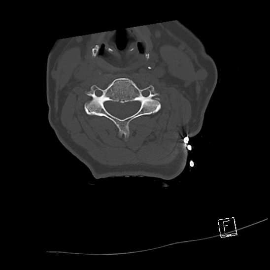 Bilateral occipital condyle fractures (type 3) (Radiopaedia 87672-104086 Axial bone window 41).jpg