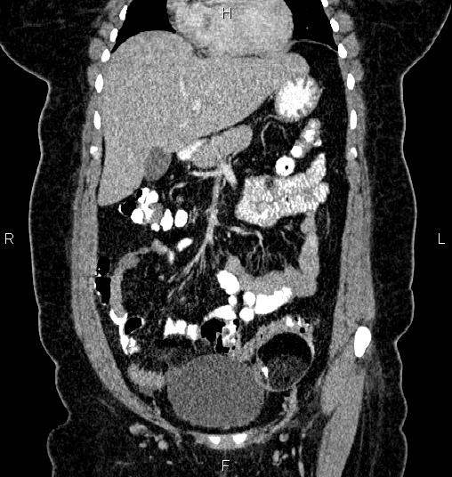 Bilateral ovarian dermoid cysts (Radiopaedia 85785-101603 C 14).jpg