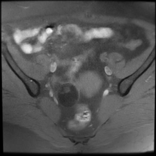 File:Bilateral ovarian dermoid cysts (Radiopaedia 90152-107338 Axial T1 fat sat 8).jpg