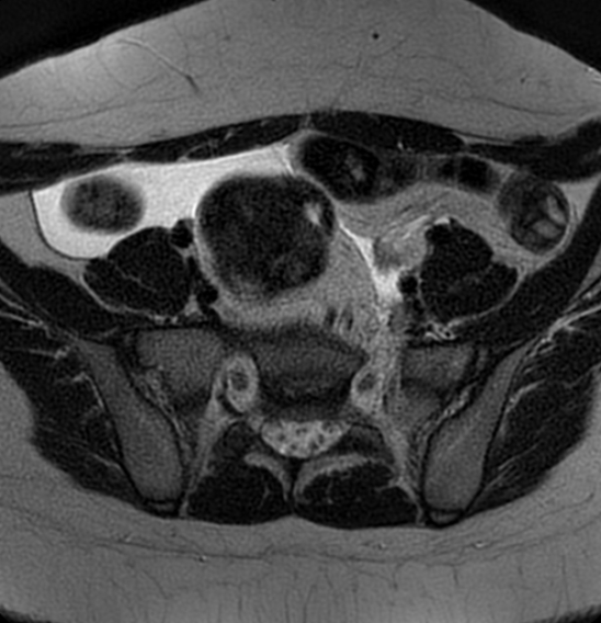 File:Bilateral ovarian fibrothecomas - adolescent (Radiopaedia 86604-102707 Axial T2 10).jpg
