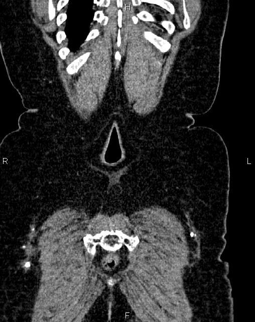 Bilateral ovarian serous cystadenocarcinoma (Radiopaedia 86062-101989 D 54).jpg