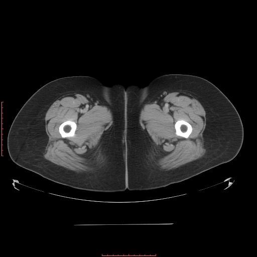 File:Bilateral ovarian serous cystadenocarcinoma with right ovarian torsion (Radiopaedia 32640-33611 A 48).jpg
