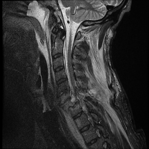 File:Bilateral perched facets with cord injury (Radiopaedia 45587-49714 Sagittal STIR 10).jpg