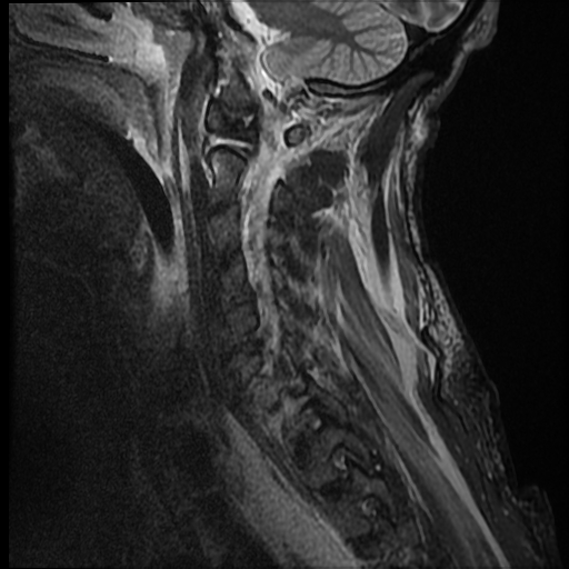 File:Bilateral perched facets with cord injury (Radiopaedia 45587-49714 Sagittal STIR 12).jpg