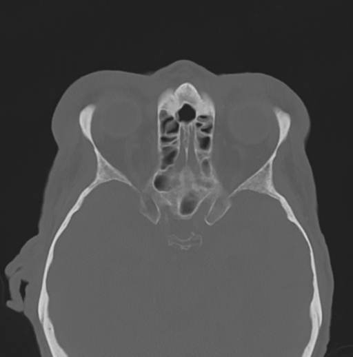File:Bilateral preseptal periorbital cellulitis (Radiopaedia 43081-46350 Axial bone window 14).png