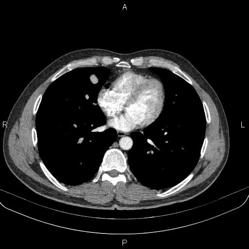 Bilateral pulmonary AVM (Radiopaedia 83134-97505 A 46).jpg