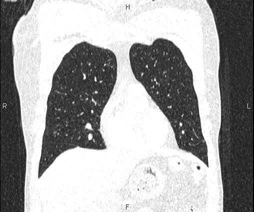 File:Bilateral pulmonary AVM (Radiopaedia 83134-97505 Coronal lung window 28).jpg