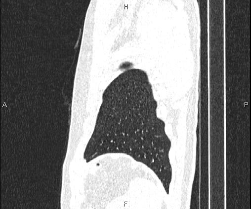 Bilateral pulmonary AVM (Radiopaedia 83134-97505 Sagittal lung window 101).jpg