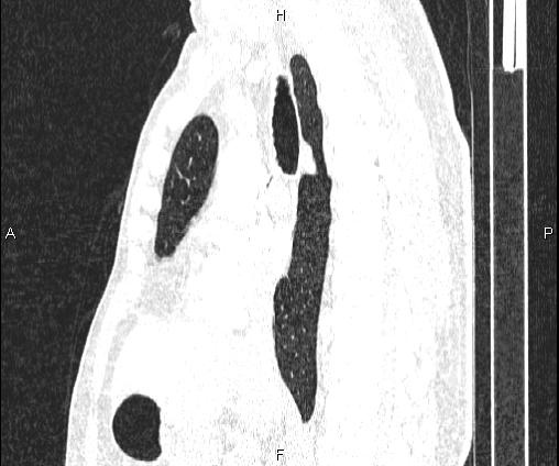 Bilateral pulmonary AVM (Radiopaedia 83134-97505 Sagittal lung window 57).jpg