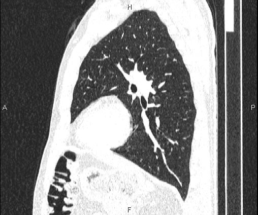 Bilateral pulmonary AVM (Radiopaedia 83134-97505 Sagittal lung window 76).jpg