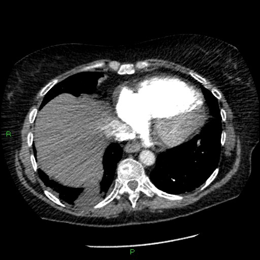 File:Bilateral pulmonary emboli (Radiopaedia 32700-33669 Axial C+ CTPA 84).jpg