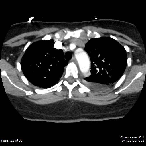 Bilateral pulmonary emboli with Hampton hump sign (Radiopaedia 54070-60246 Axial C+ CTPA 19).jpg