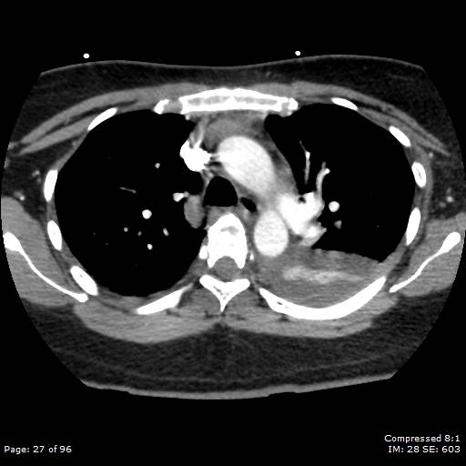 Bilateral pulmonary emboli with Hampton hump sign (Radiopaedia 54070-60246 Axial C+ CTPA 24).jpg