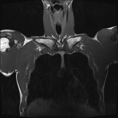 File:Bilateral spinoglenoid notch ganglion cysts (Radiopaedia 29577-30082 Coronal T1 5).jpg