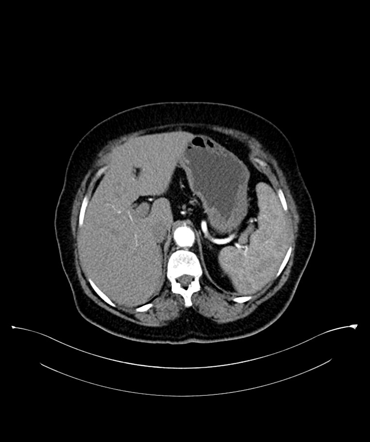 Bilateral sporadic synchronous clear cell renal cell carcinoma (Radiopaedia 85035-100575 B 29).jpg