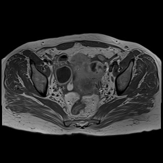 Bilateral tubo-ovarian abscesses (Radiopaedia 58635-65829 Axial T1 C+ 27).jpg
