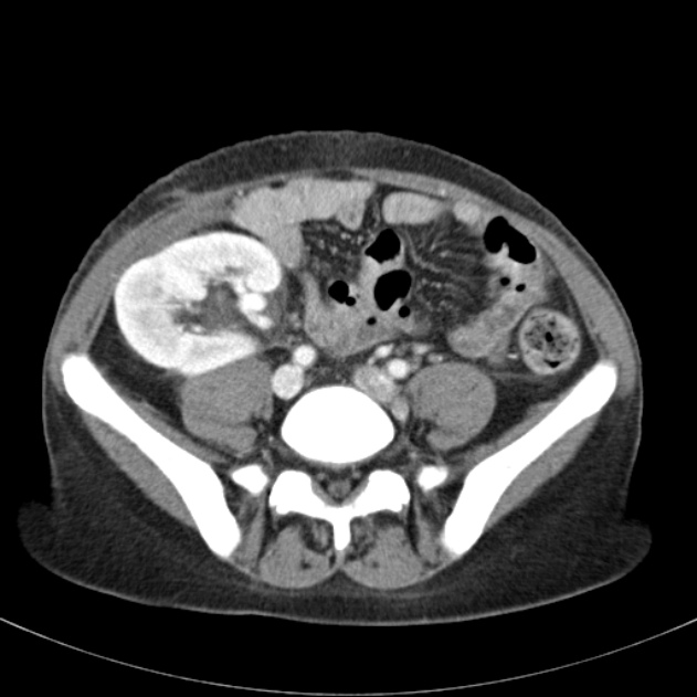 Biliary necrosis - liver transplant (Radiopaedia 21876-21846 B 54).jpg
